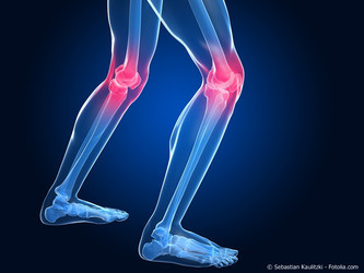 Darstellung von Arthrose bzw. Arthritis in den Knien