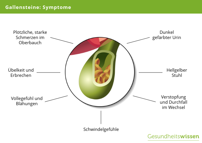 Symptome bei Gallensteinen