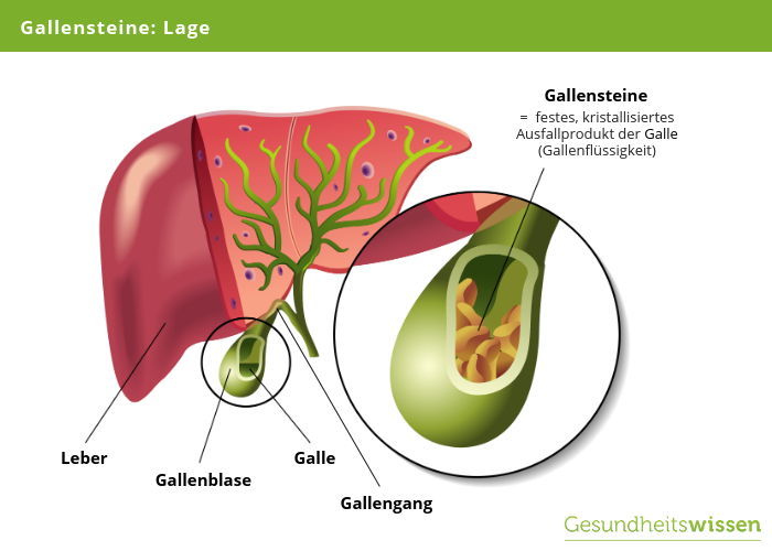 Gallensteine entstehen in der Gallenblase