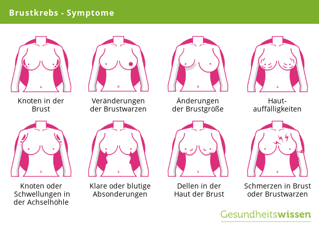 Brustkrebs Symptome