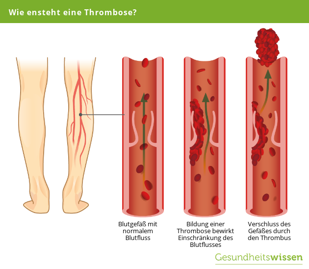 Thrombose Ursache