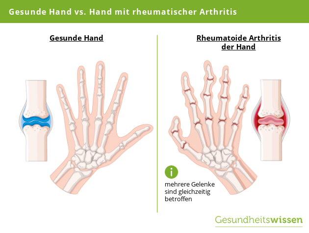 Gesunde Hand vs rheumatoide Hand