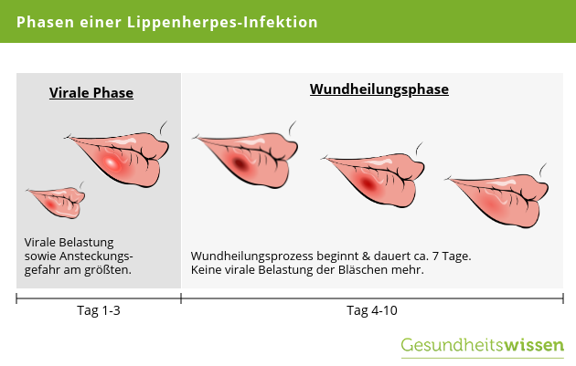 Genitalis anzeichen herpes Herpes genitalis: