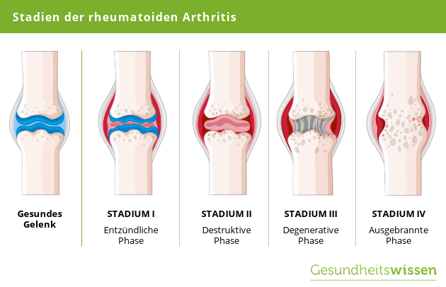 Stadien der rheumatoiden Arthritis