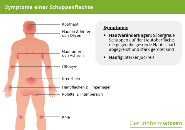 Symptome Schuppenflechte