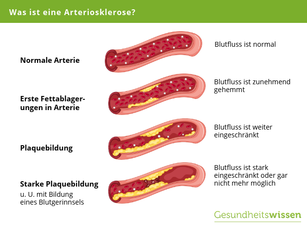 Arteriosklerose