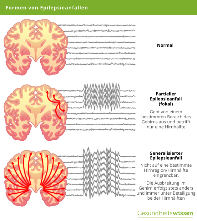 Epilepsie Formen
