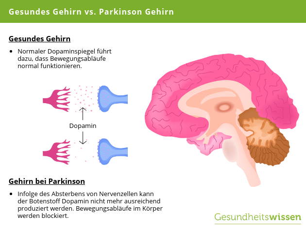 Gesundes Gehirn vs Parkinson Gehirn