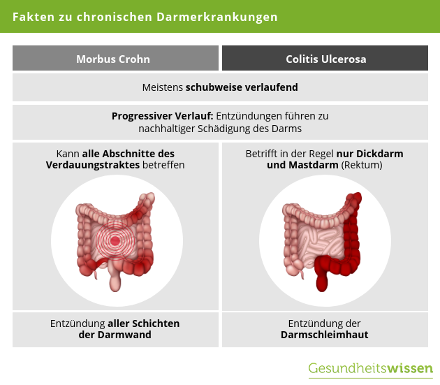 Unterschied zw. Morbus Crohn und Colitis Ulcerosa